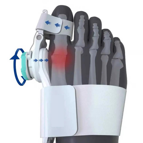 Orthèse Ajustable Pour Hallux Valgus